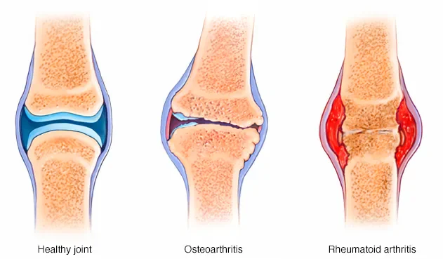 differences between arthritis and bursitis