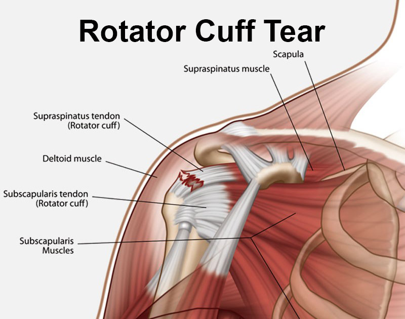 rotator cuff tear