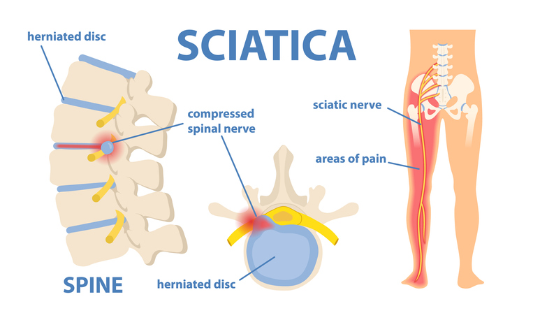 how to know if your chronic pain is caused by Sciatica