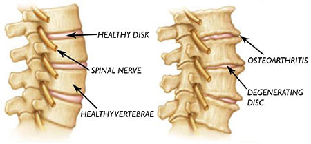 Are Your Painful Headaches Caused By Neck Arthritis