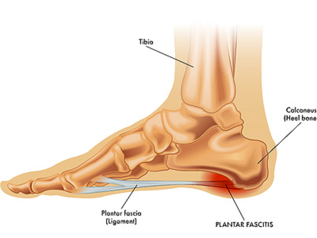Anatomical Diagram of plantar fascia near heel being irritated and inflamed due to Jogger's Heel.