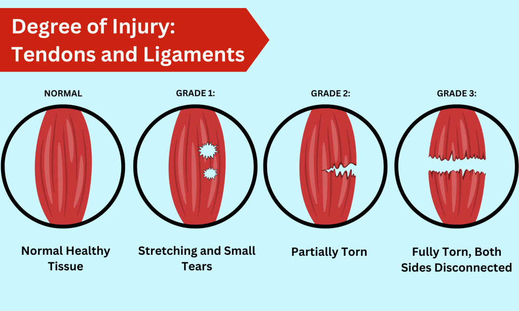 Ligament and Tendon Injuries degrees of a tear